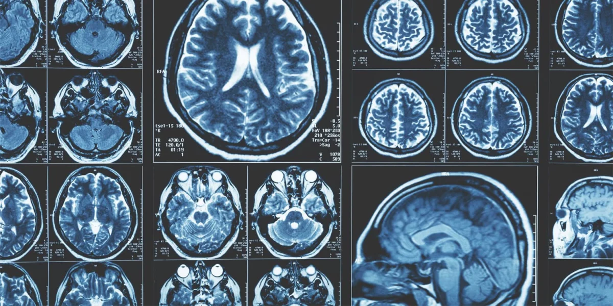 Spike in brain attacking autoantibodies linked to early COVID-19 pandemic