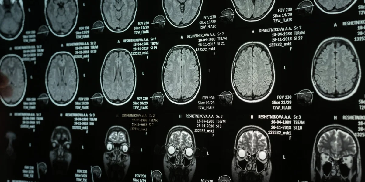 The interrelation of emotion regulation, anterior insula structure, and narcissistic traits