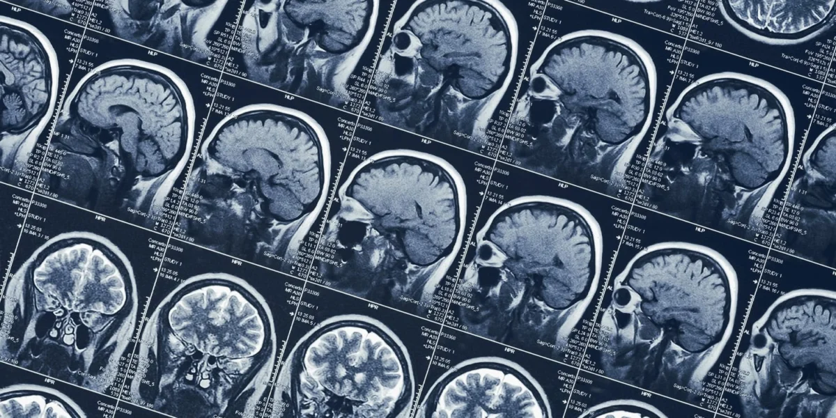 People working in shifts undergo gradual shrinkage of two brain regions