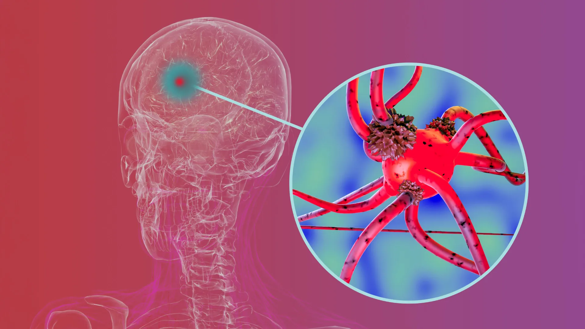 Unlocking Parkinson’s Progression: Penn Researchers Identify Key Brain Immune Protein as a Therapeutic Target