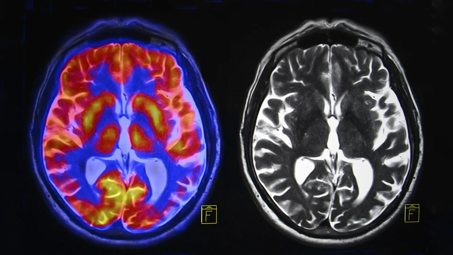 Autism May Encompass at Least Two Distinct Biological Subtypes Defined by Brain Communication Patterns