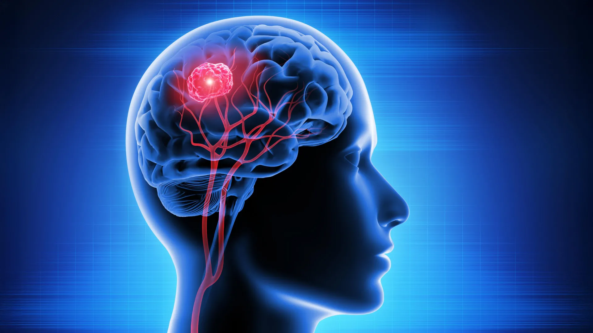 New vitamin B12 therapy shows promise against deadly brain cancer