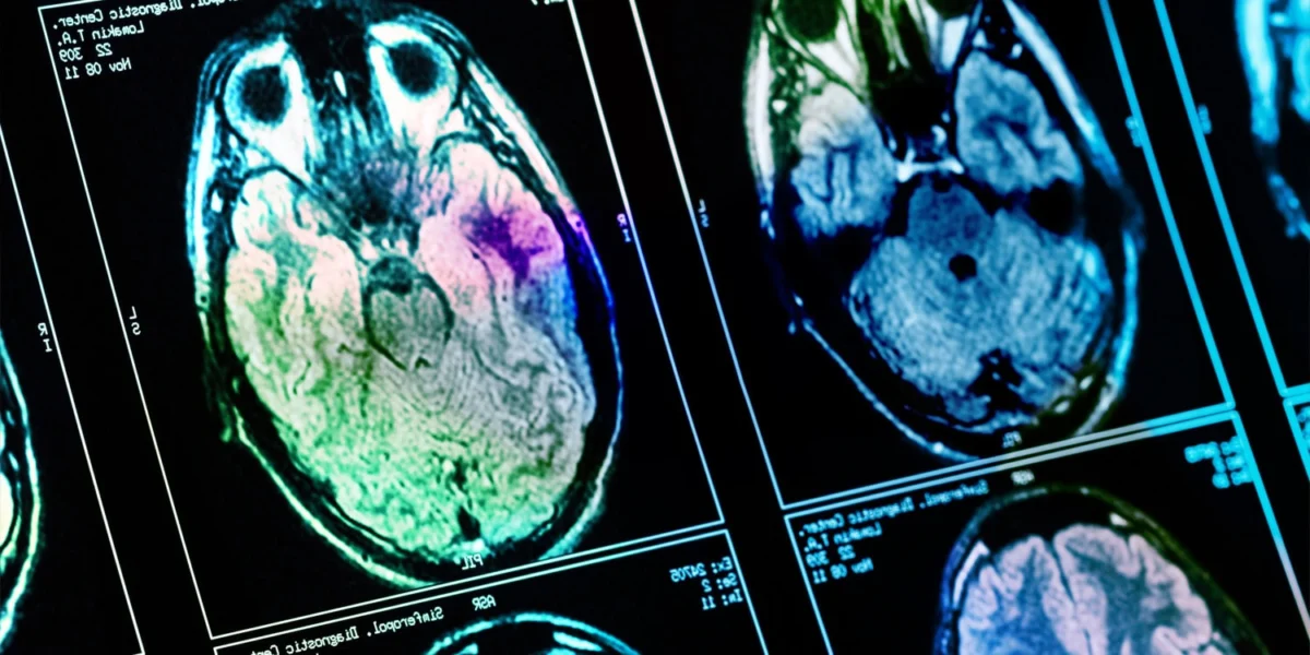 Brain structure variations are linked to different types of traumatic memories