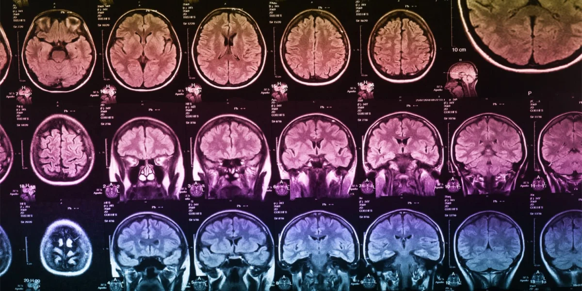 Neuroimaging study of 30,000 adults links the size of six brain areas to stronger working memory