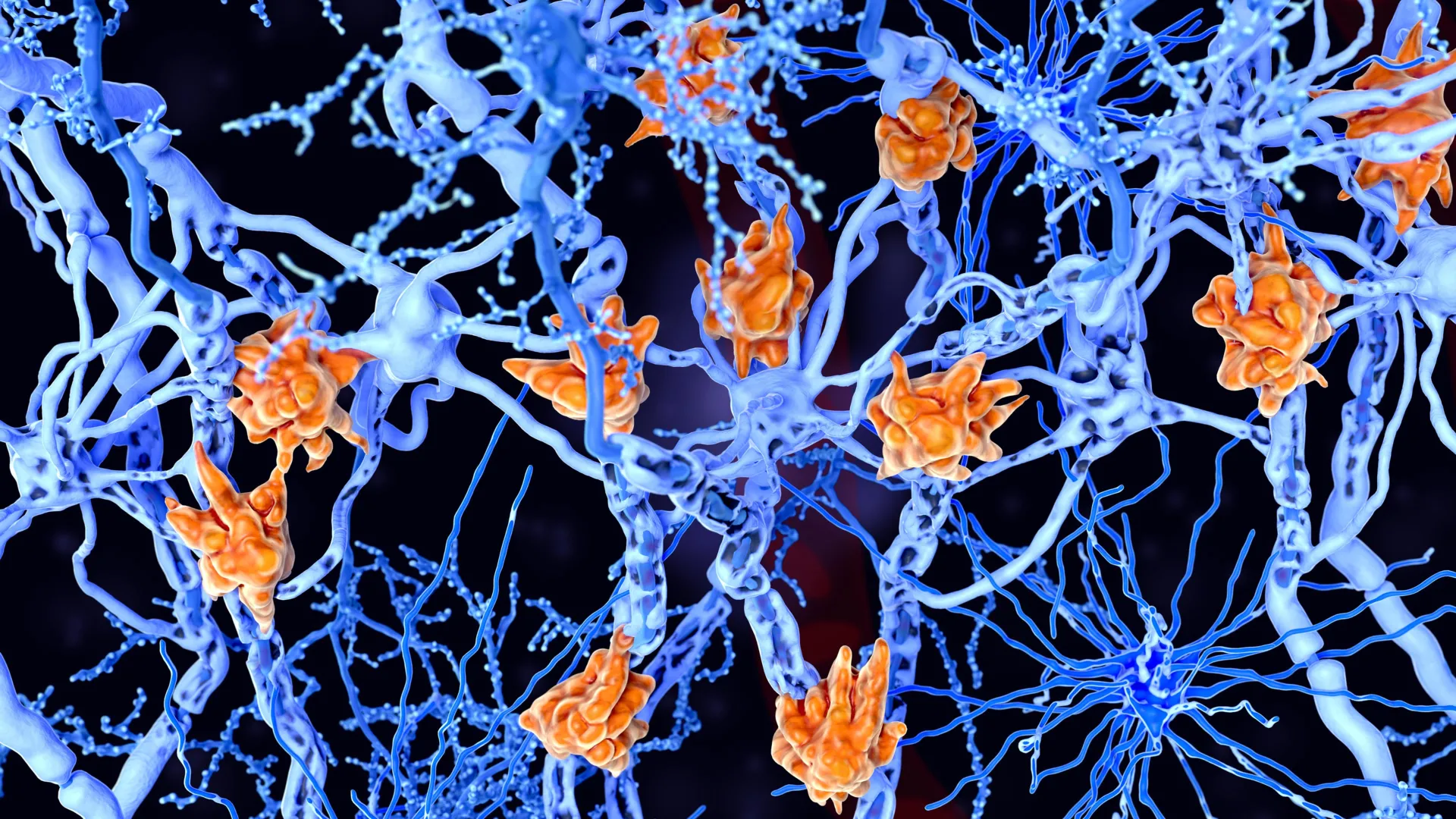 Unveiling Foamy Microglia: A Potential Key to Understanding Rapid Multiple Sclerosis Progression
