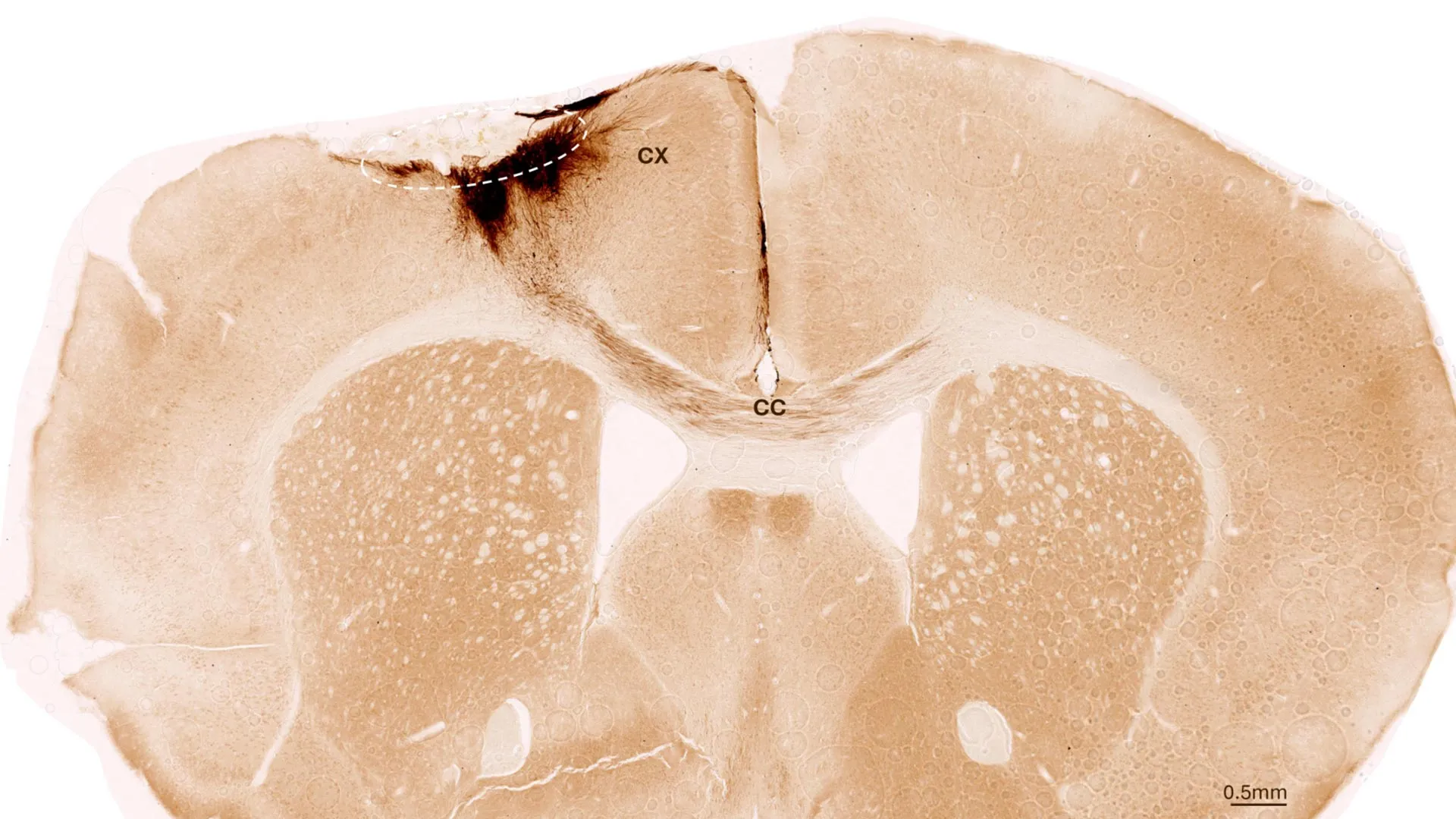 Breakthrough Research at the University of Zurich Reveals Stem Cell Therapy Could Reverse Permanent Brain Damage Following Stroke
